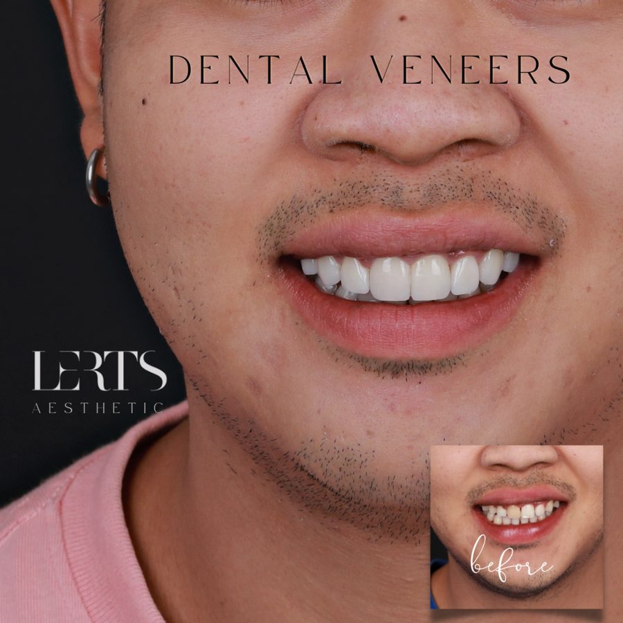 Male porcelain veneer case — finished smile with the before photo inset
