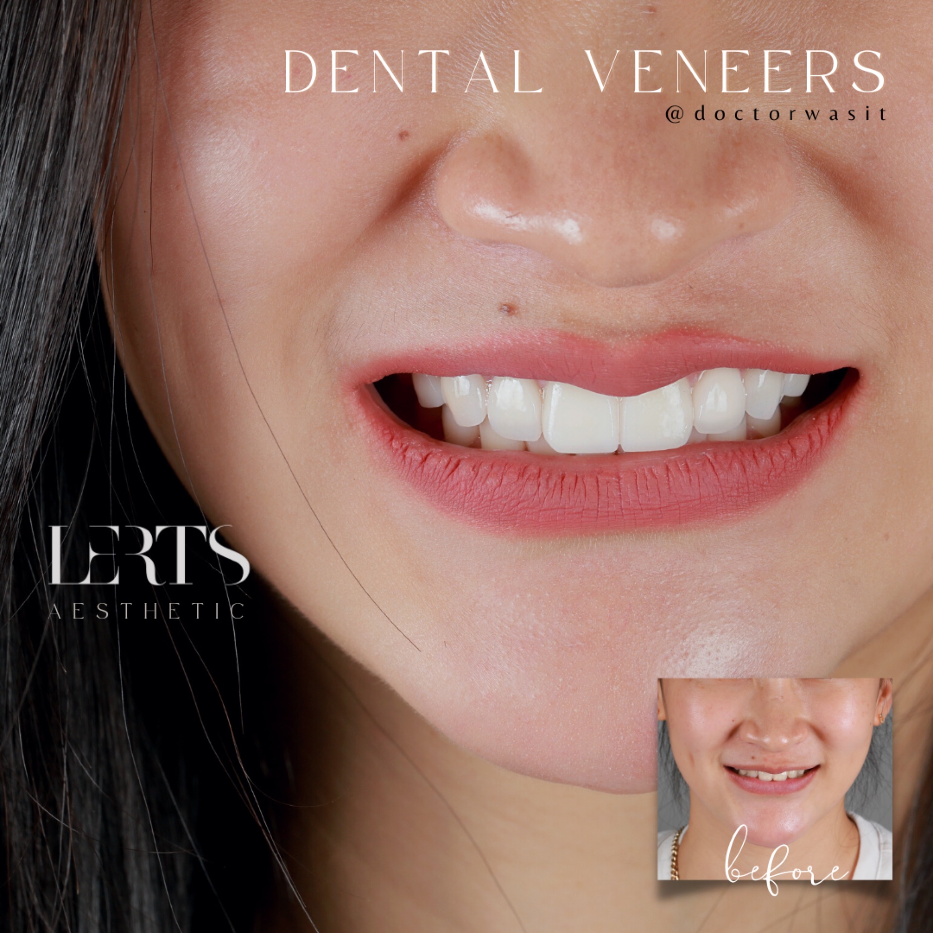 Veneer case 09