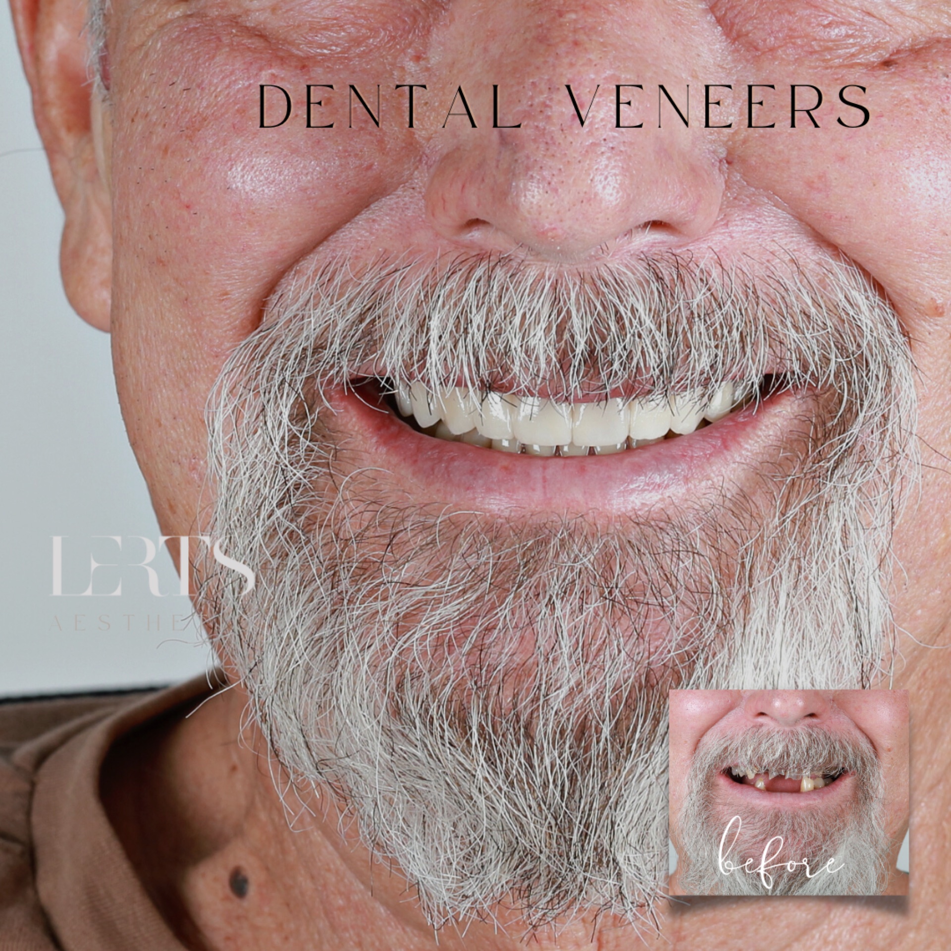 Veneer case 10