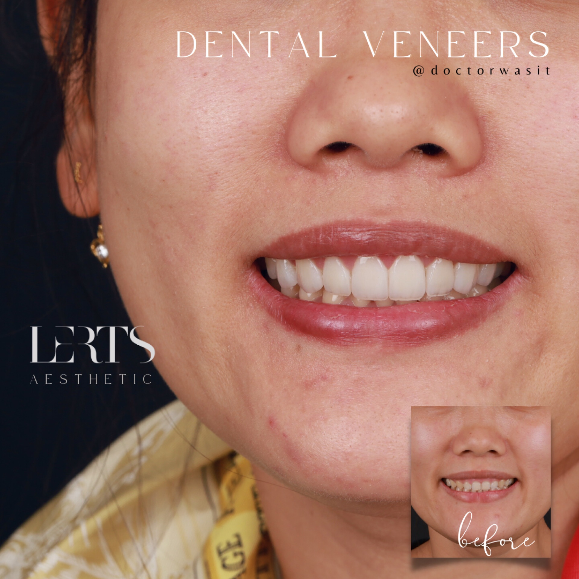 Veneer case 11