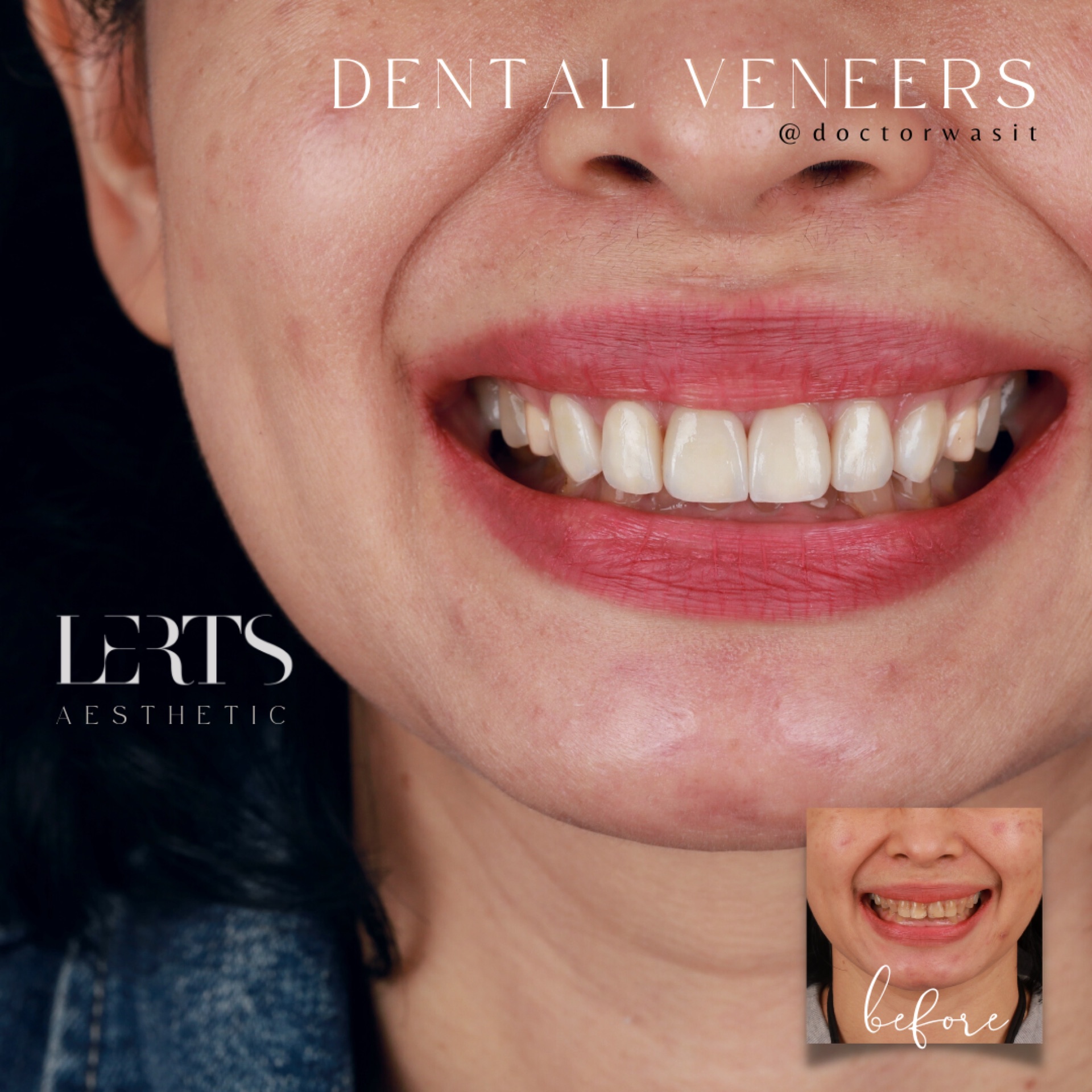 Veneer case 13
