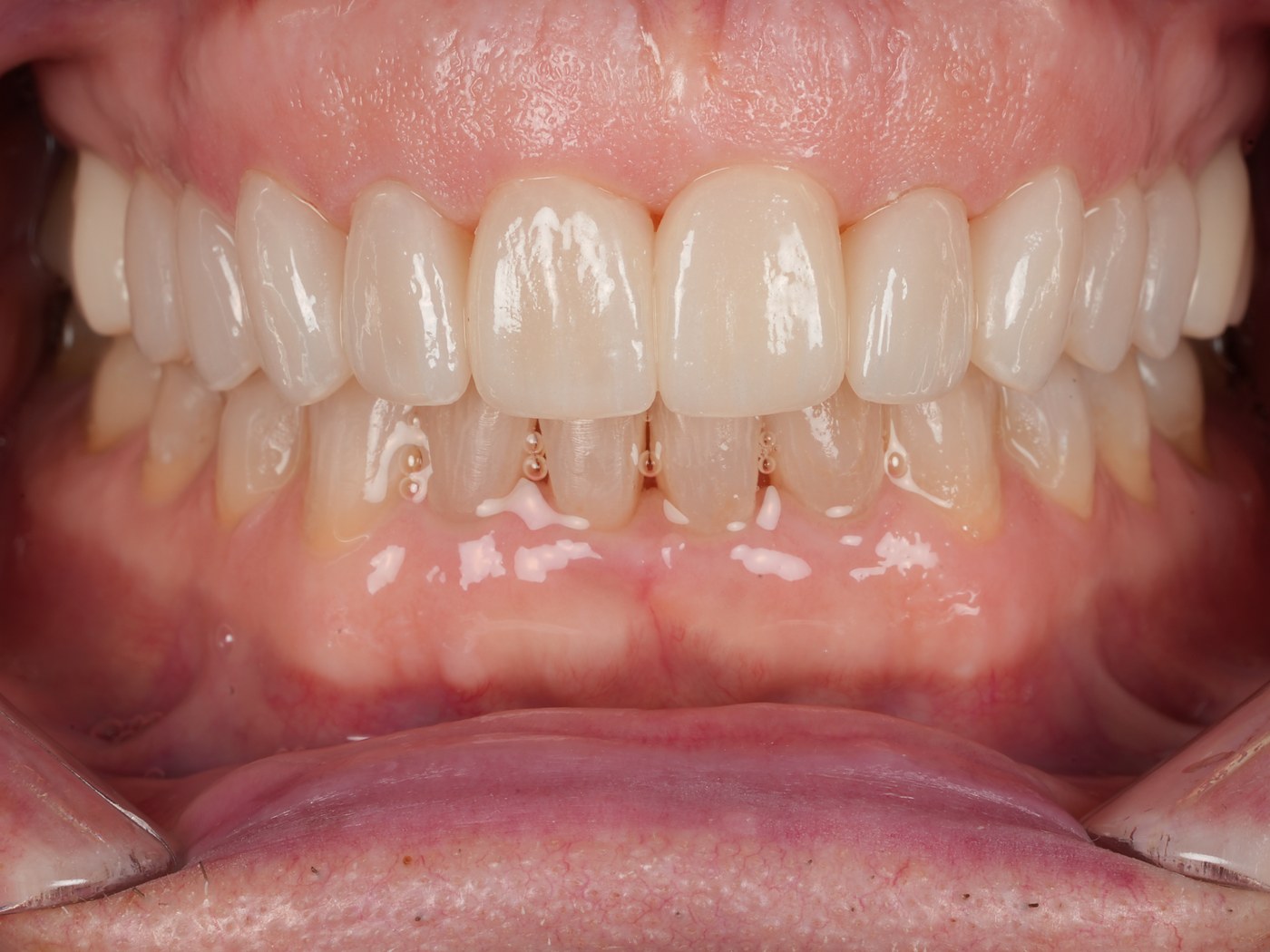 After treatment — the upper arch restored with all-ceramic crowns