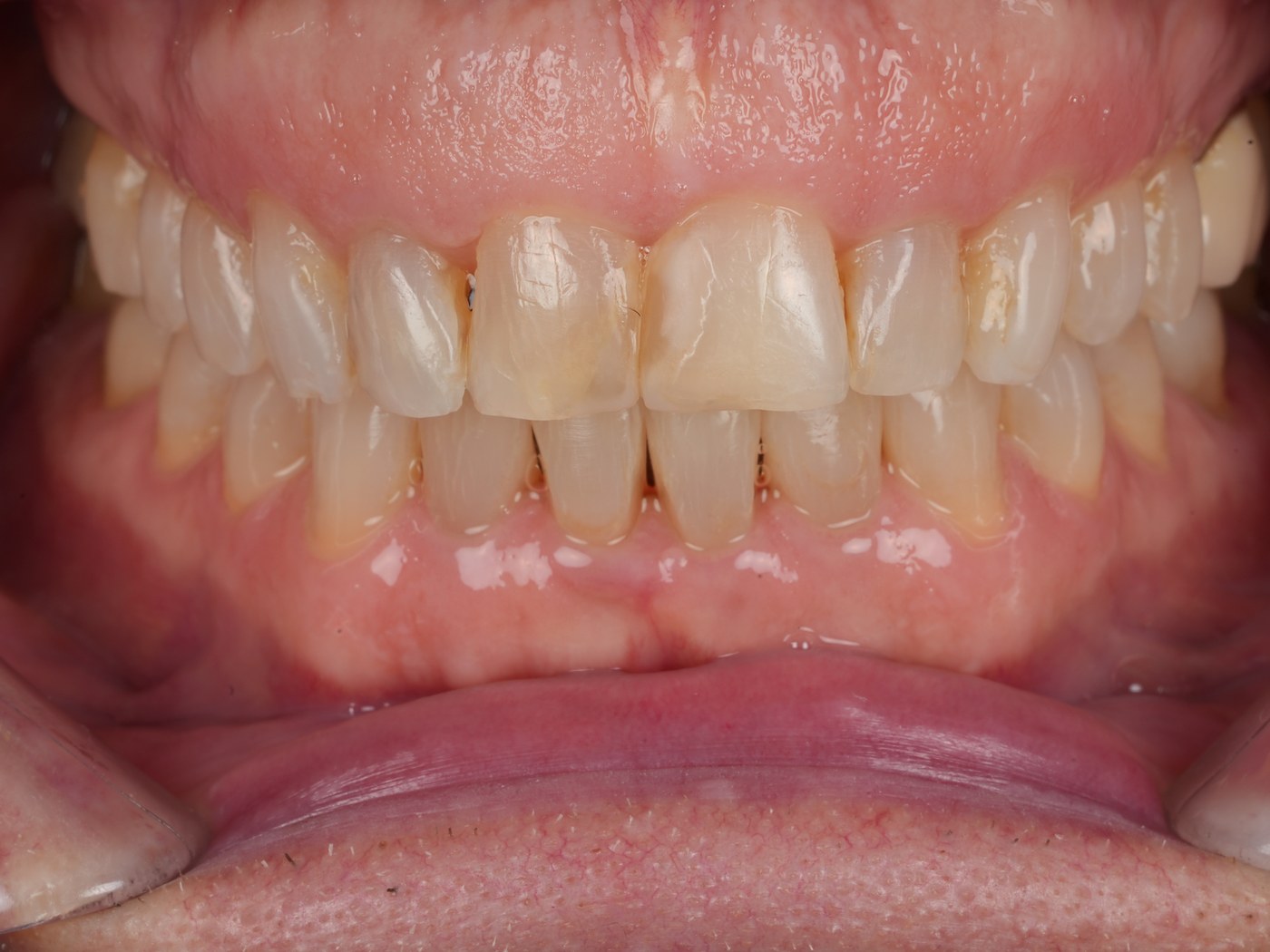 Before treatment — upper teeth with large old fillings, worn edges and stained margins