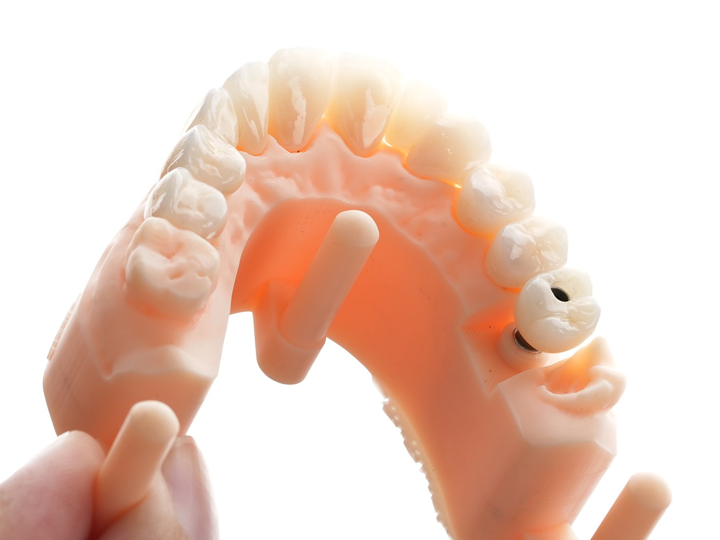 All-ceramic zirconia crowns on the working model before fitting