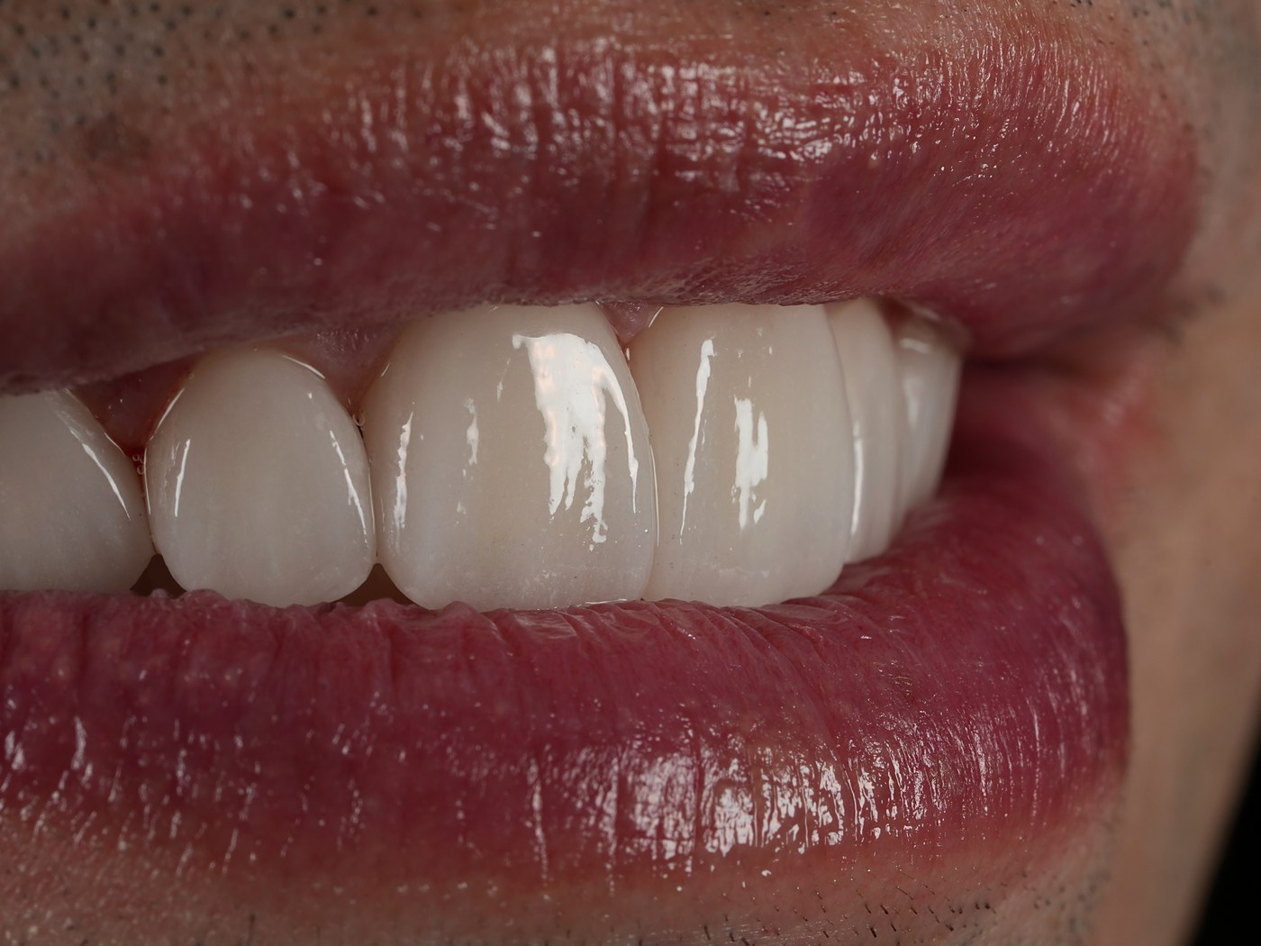 Finished all-ceramic zirconia crowns in the mouth, translucent at the edges like natural enamel