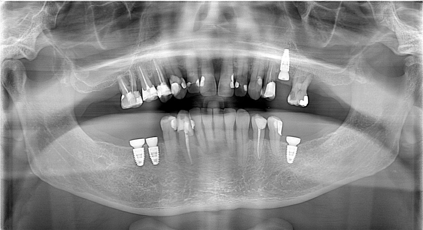 Panoramic x-ray after four dental implants placed in a single appointment