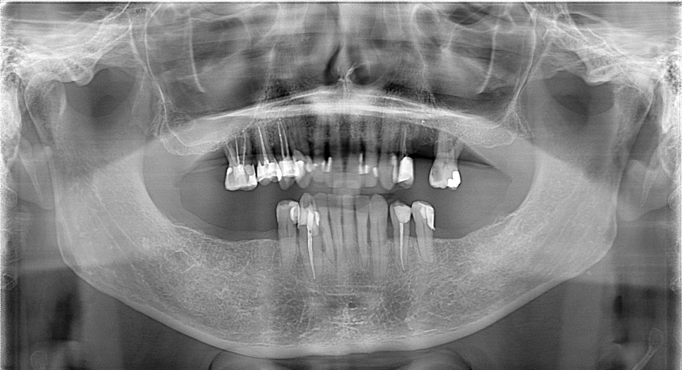 Panoramic x-ray before treatment showing four missing teeth