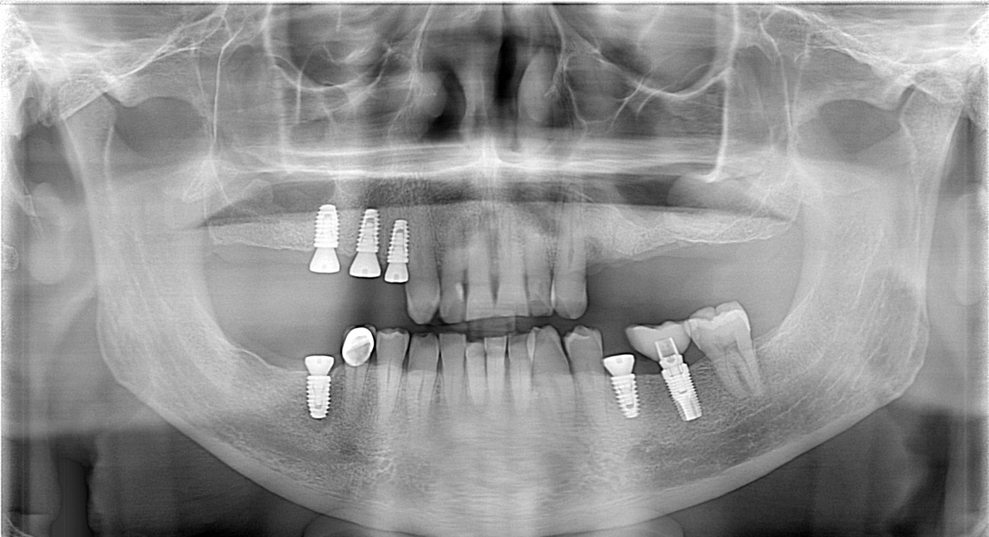 Panoramic x-ray after five dental implants placed over two appointments
