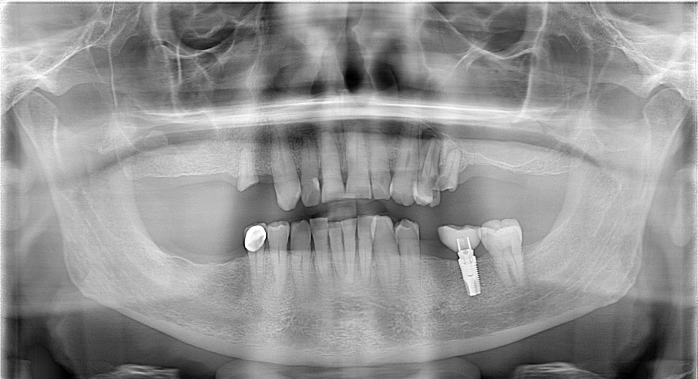 Panoramic x-ray before treatment showing several missing upper and lower teeth