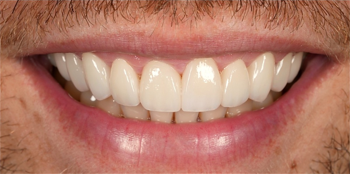 The same smile after porcelain veneers, shade matched to his own face