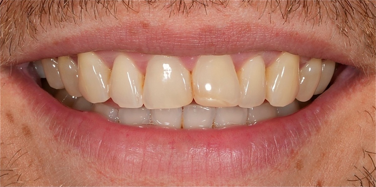 Worn, uneven and discoloured front teeth before porcelain veneers