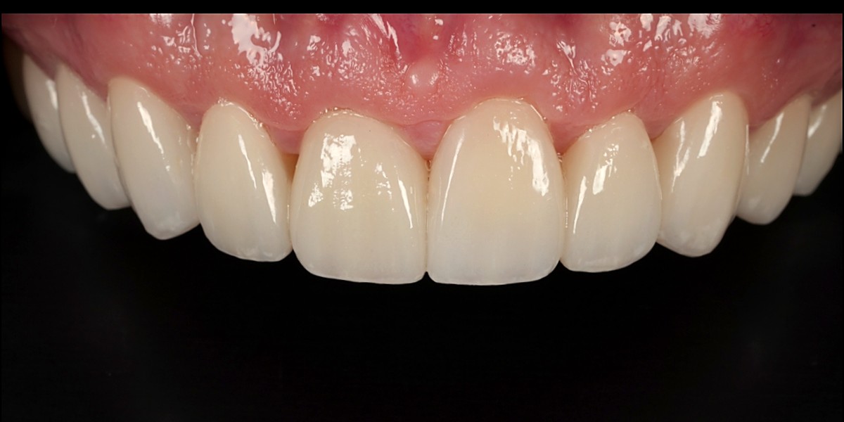 Close-up of the finished porcelain veneers with even edges and natural translucency