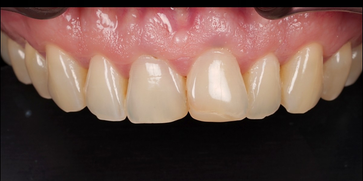 Close-up of worn, chipped and unevenly shaded upper front teeth before veneers