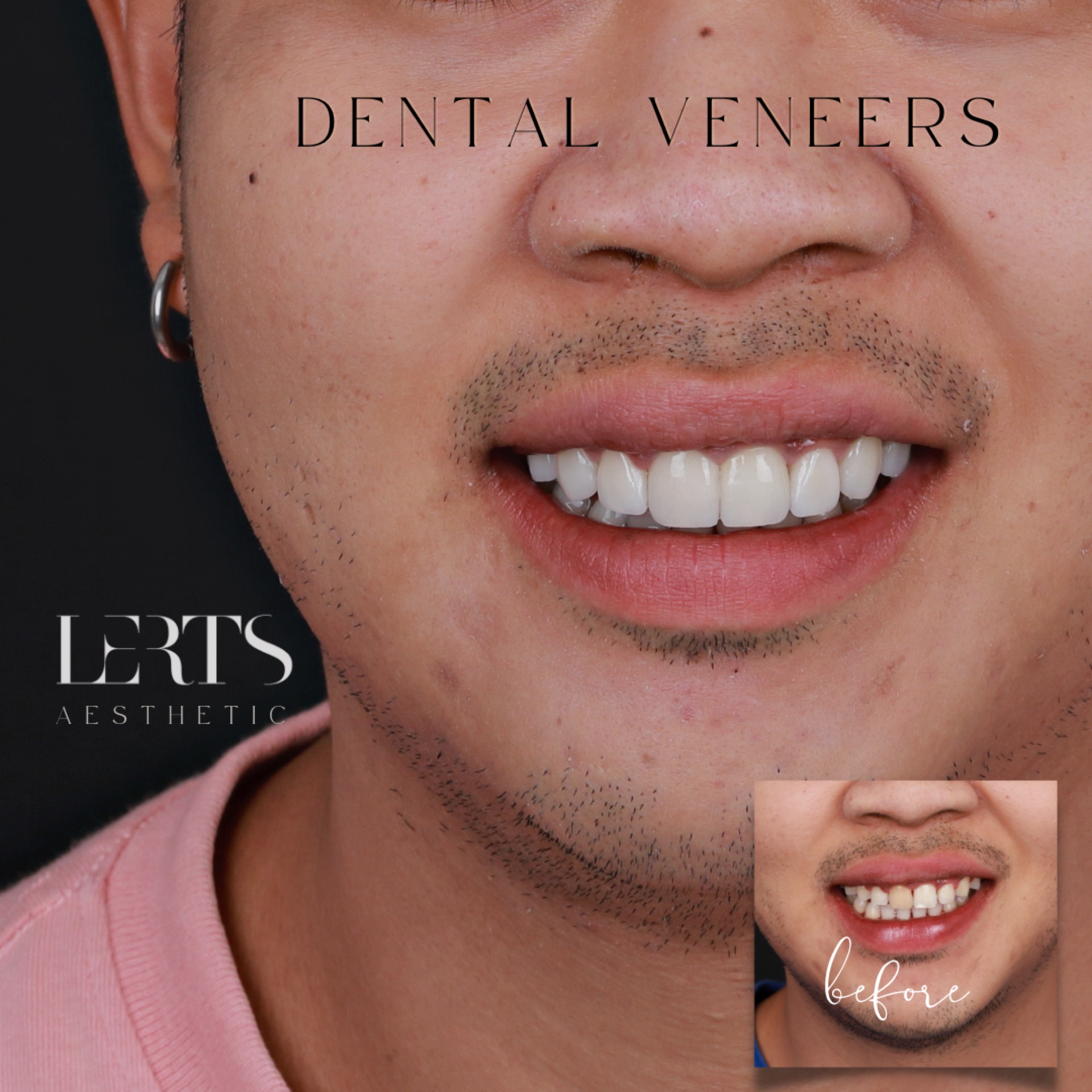 Before & after — veneers case 12