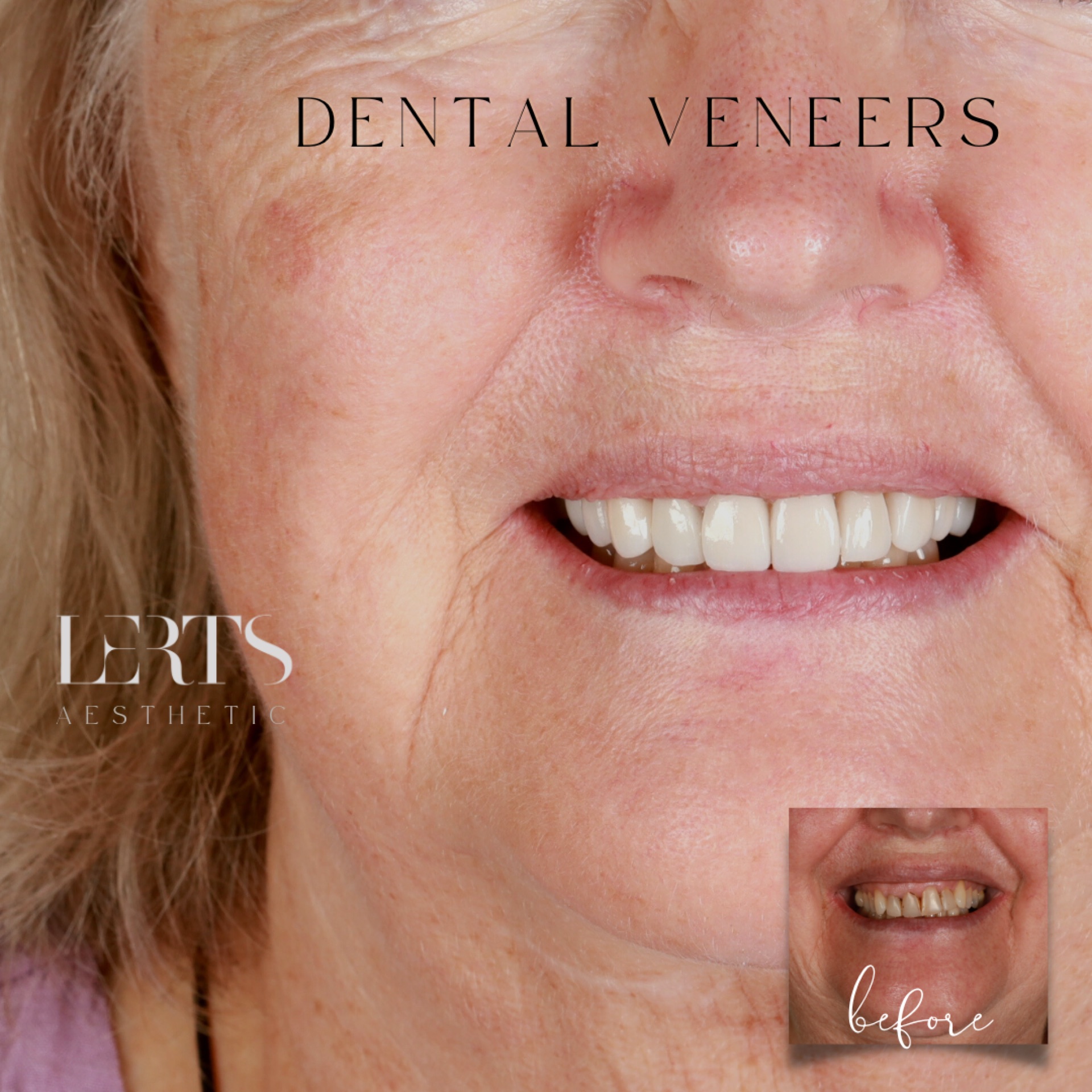 Before & after — veneers case 15