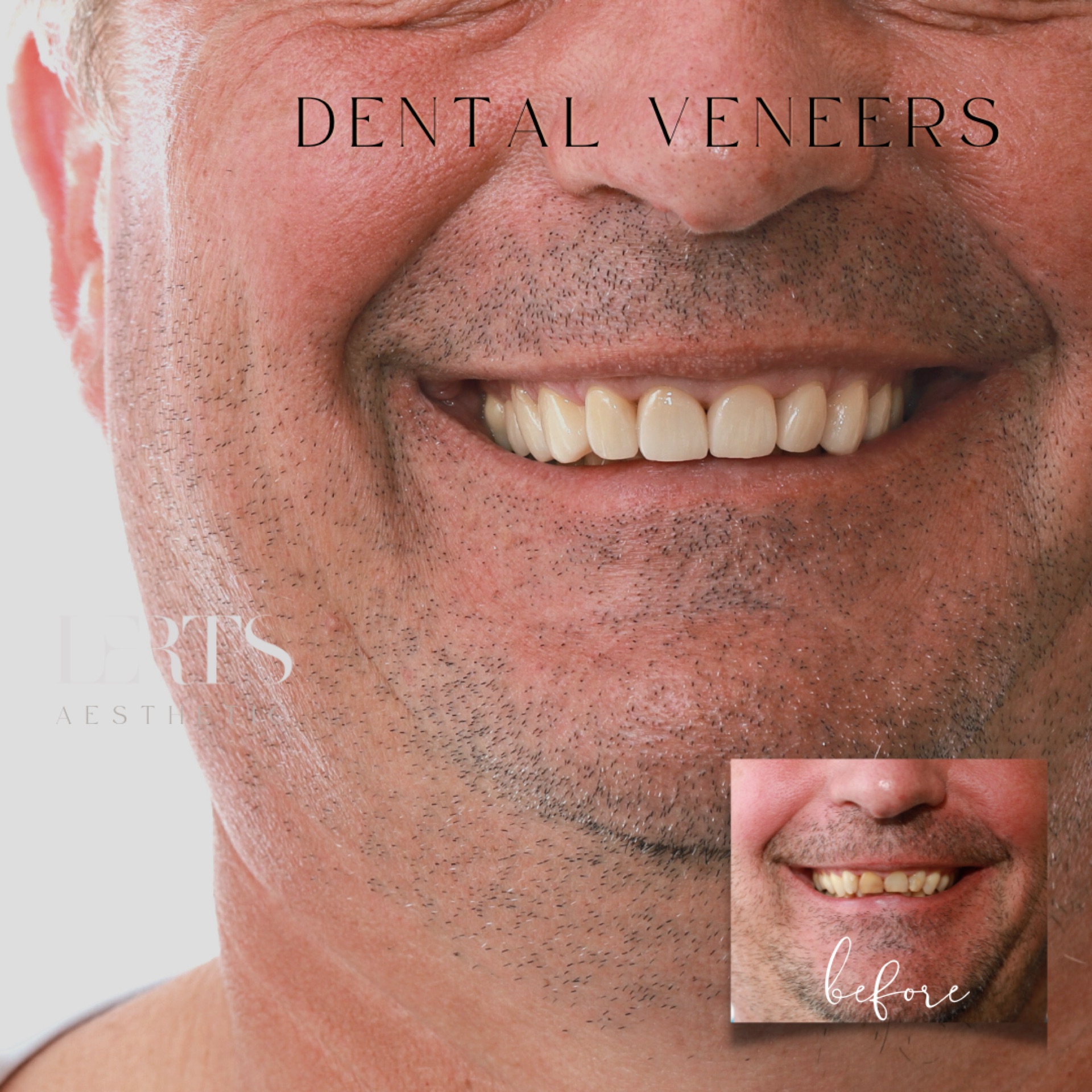 Before & after — veneers case 18