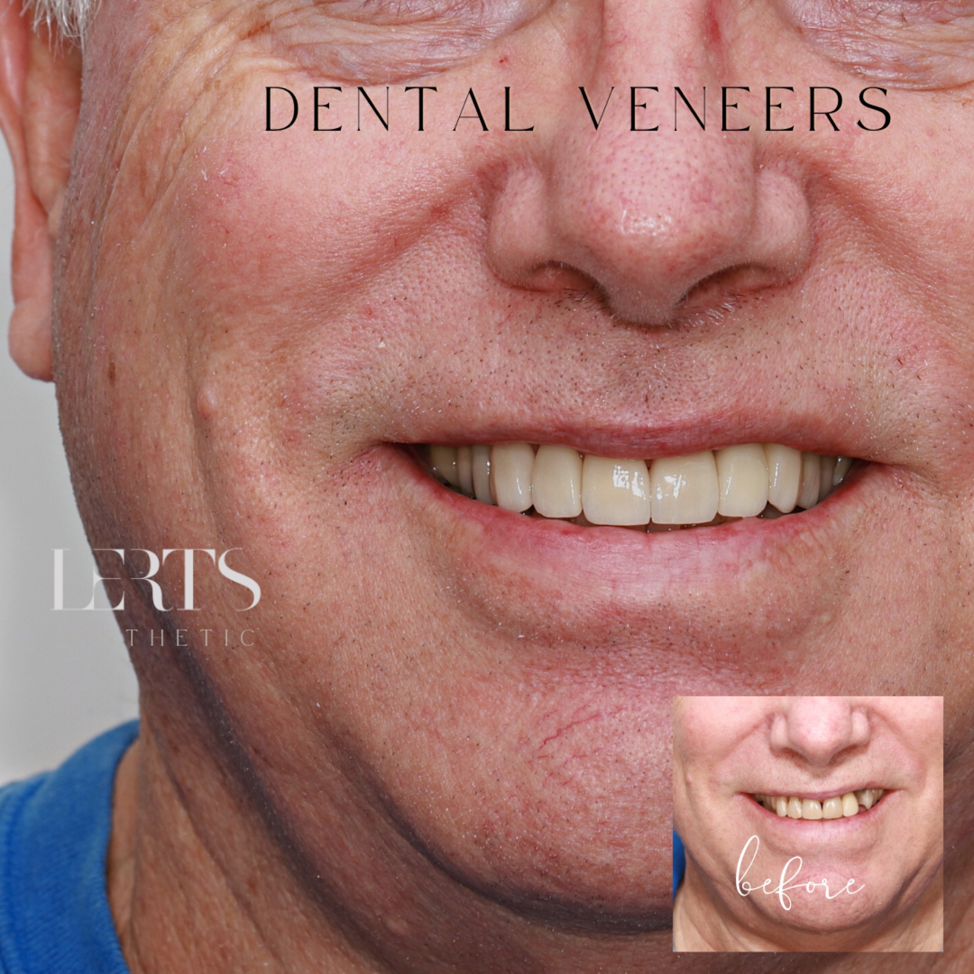 Before & after — veneers case 19