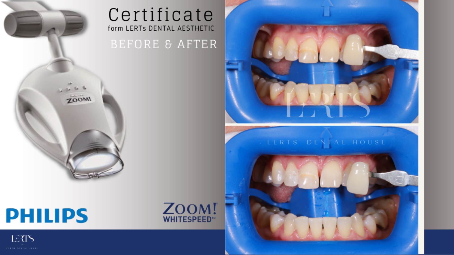 Zoom whitening before / after — 8 shades brighter