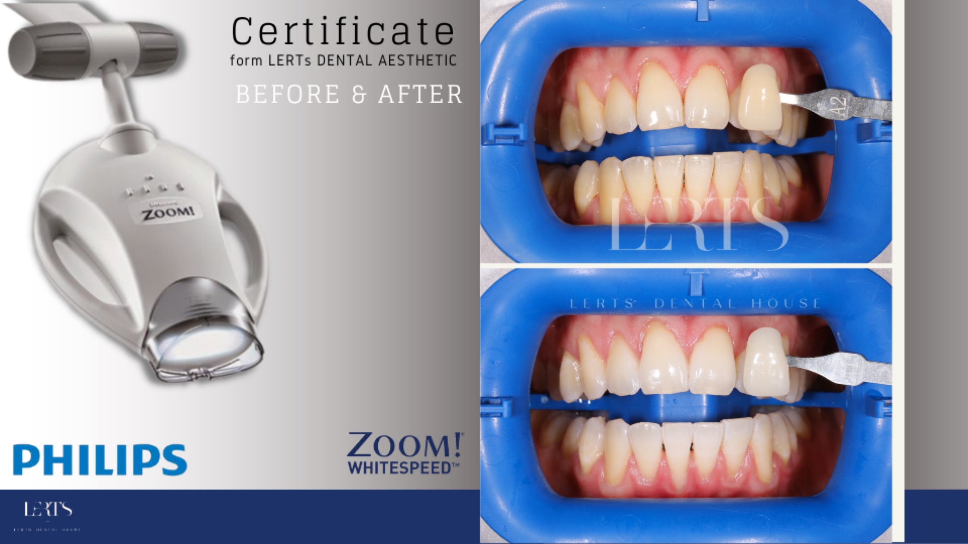 Zoom whitening before / after — 5 shades brighter