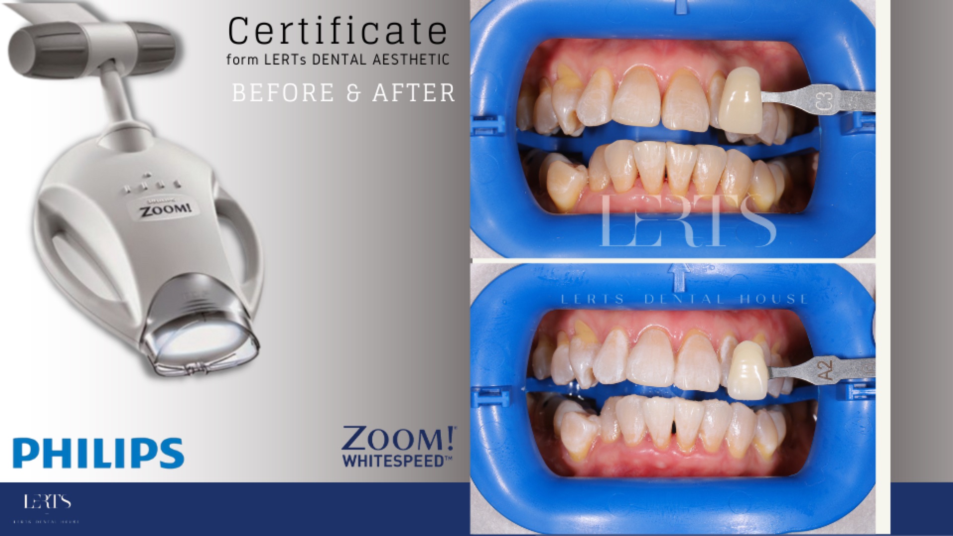 Zoom whitening before / after — 6 shades brighter