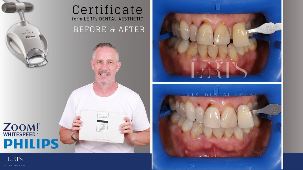 Zoom whitening before and after — Vita shade B3 → B2