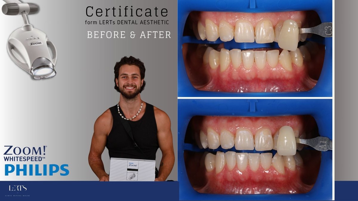 Zoom whitening before and after — Vita shade C3 → A1