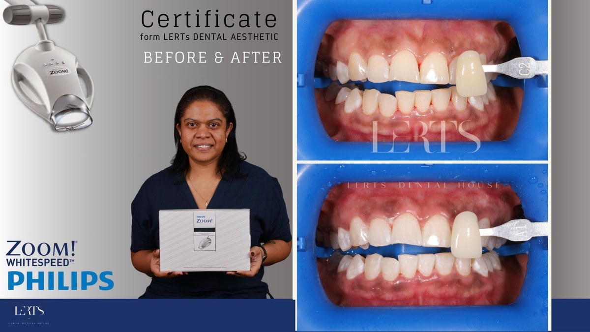 Zoom whitening before and after — Vita shade C2 → A1