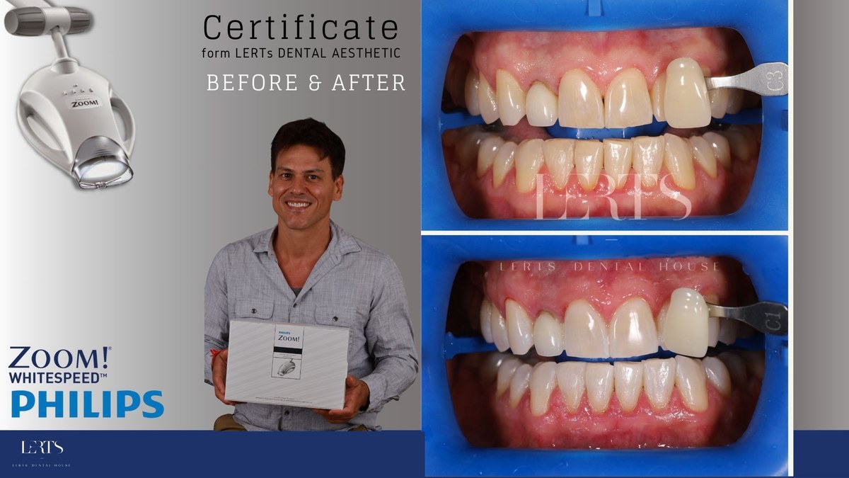 Zoom whitening before and after — Vita shade C3 → C1