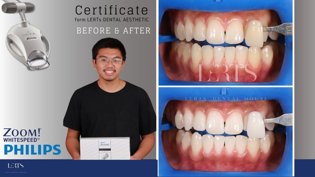 Zoom whitening before and after — Vita shade D3 → 0M3