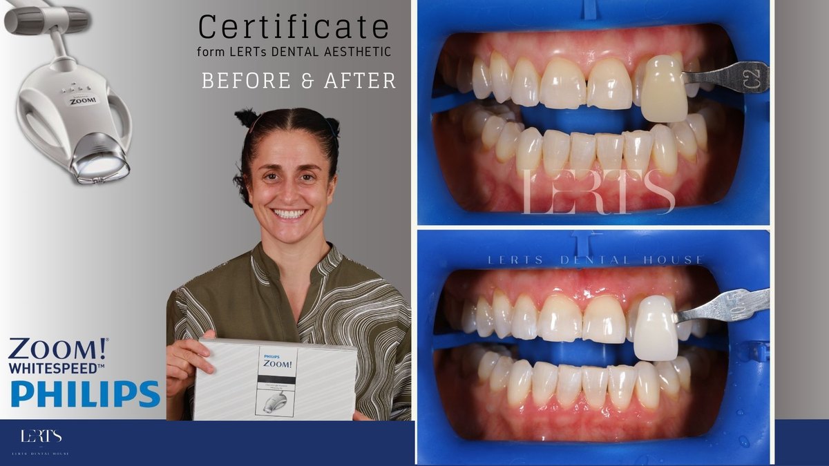 Zoom whitening before and after — Vita shade C2 → W0.5