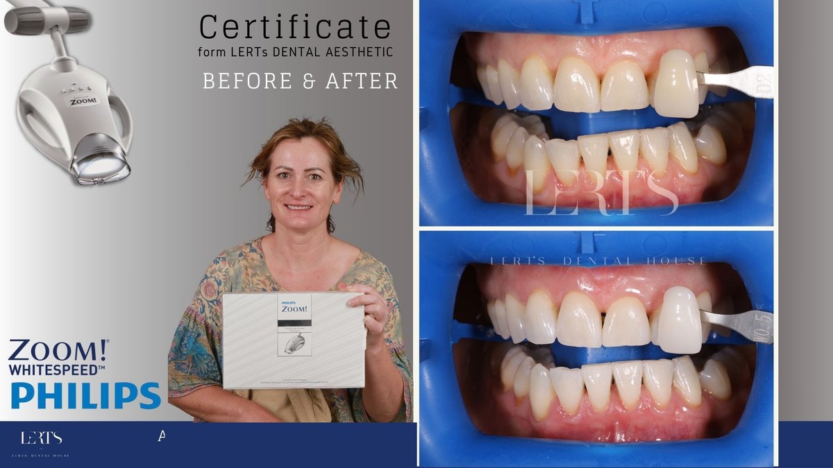 Zoom whitening before and after — Vita shade D2 → W0.5