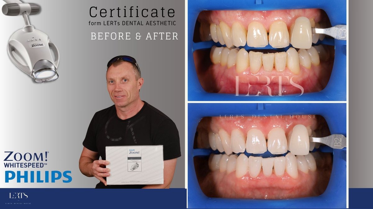 Zoom whitening before and after — Vita shade C3 → B2