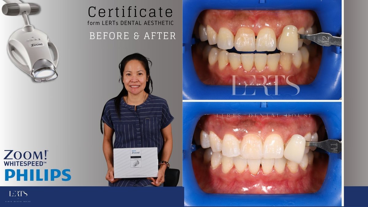 Zoom whitening before and after — Vita shade A2 → A1