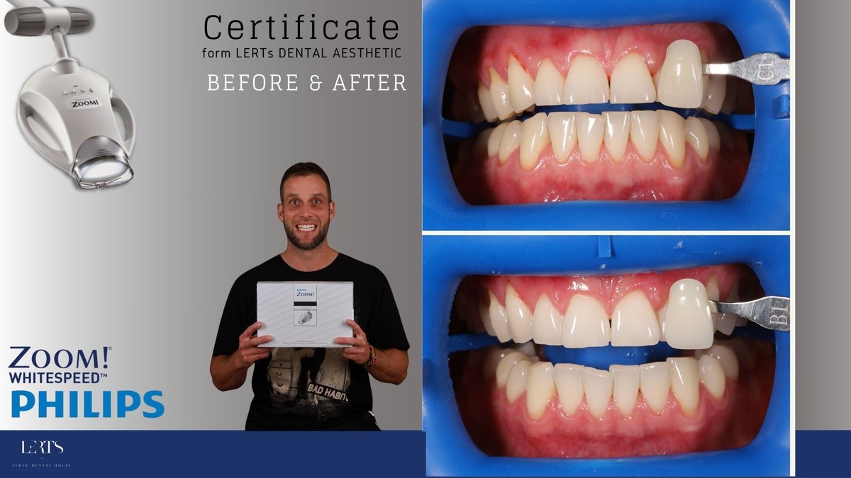 Zoom whitening before and after — Vita shade C1 → B1
